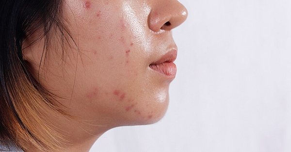 Vì sao mụn không dứt dù skincare đều đặn? Giải pháp cùng dược mỹ phẩm Việt Trioderma