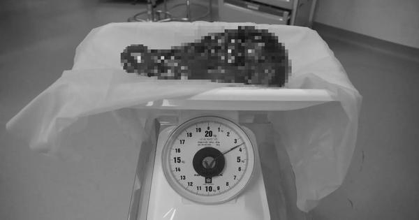 Lá lách nặng 3,5 kg chiếm gần hết ổ bụng, bệnh nhân phải phẫu thuật