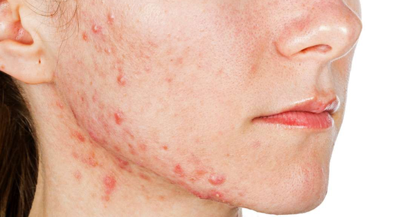 Mụn không chỉ là câu chuyện tuổi dậy thì: Vì sao người trưởng thành vẫn bị mụn?