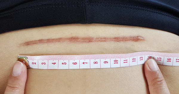 Đứng trước gương 6 tuần sau sinh, mẹ có nên quan tâm vết sẹo mổ sau sinh?