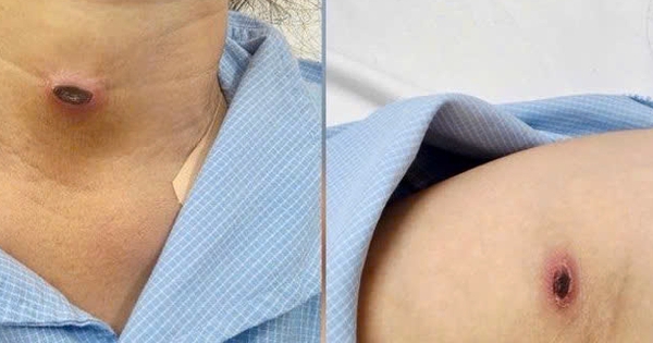 Nhận diện bệnh sốt mò