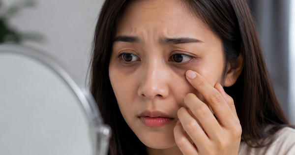 Ngủ đủ vẫn quầng thâm mắt: Vì sao?