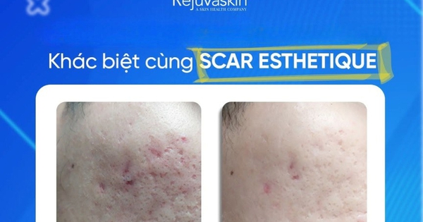 Kem mờ sẹo rỗ nào hiệu quả với cả sẹo lâu năm mà không cần xâm lấn?