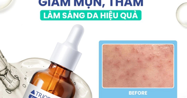 Serum giúp ngừa mụn, sáng da Trioderma ActiBalance+ Serum có tốt không mà ‘cháy hàng’ liên tục?