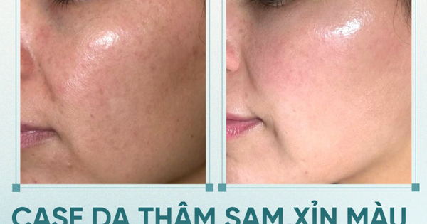 +5 serum mờ nám mảng, nám chân sâu; hiệu quả cả nám lâu năm không xâm lấn