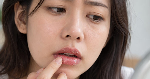 4 biểu hiện trên môi do cơ thể thiếu chất, mắc bệnh