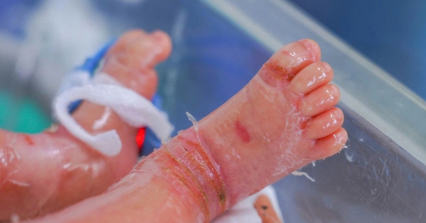 Bé trai sinh non mắc bệnh vảy cá hiếm gặp, hồi phục sau 12 ngày điều trị