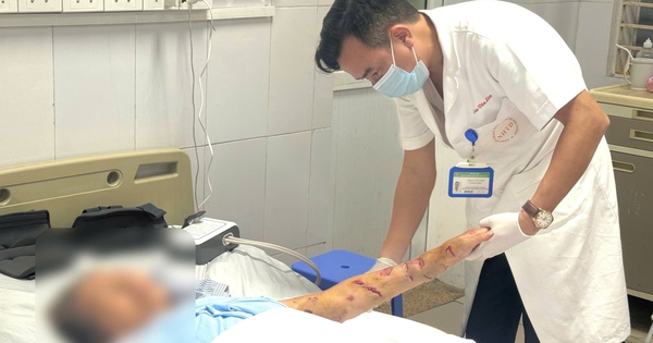 Cẩn trọng khi nhà có chó nuôi con