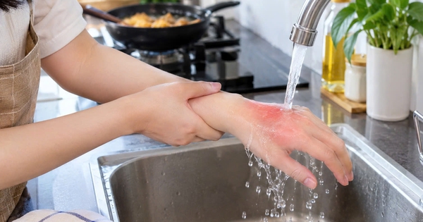 Bỏng tại nhà: 5 cách sơ cứu cần biết