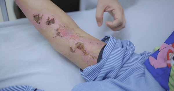 Bất ngờ bị sét đánh trên đường về nhà, người phụ nữ bỏng nặng