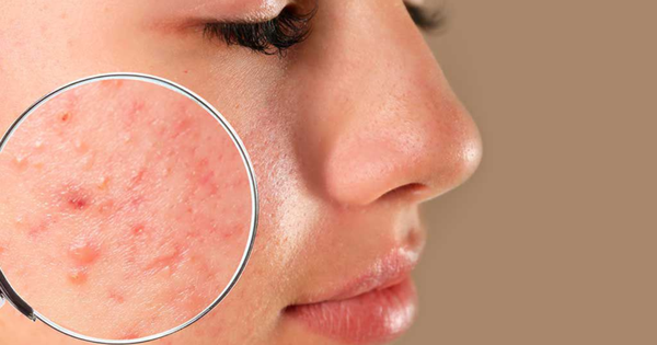 Da dầu mụn, mụn viêm sưng nên dùng gì? Gợi ý routine chuẩn y khoa từ Trioderma