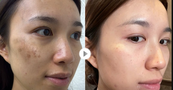 Top 3 kem giúp mờ nám chân đinh, đốm nâu lâu năm và không lo tái phát