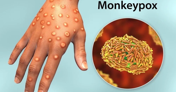 Bệnh đậu mùa khỉ và bệnh thủy đậu có cùng phương pháp điều trị không?
