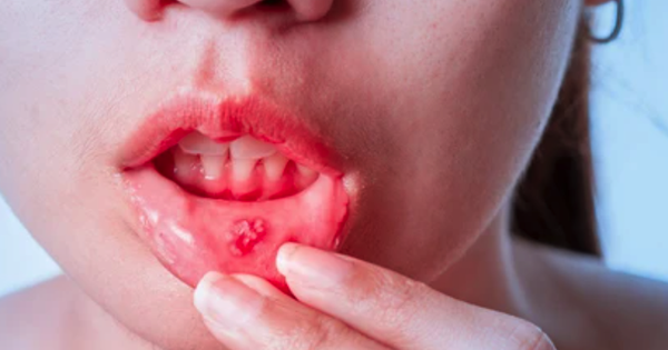 Cách điều trị nhiệt miệng màu đen hiệu quả bạn cần biết