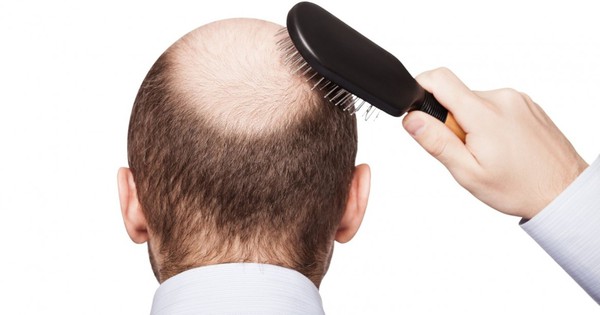 Tìm hiểu về nguyên nhân gây rụng tóc ở nam và cách khắc phục