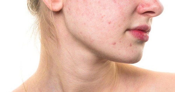 Những nguyên nhân gây ra mụn mủ trên da là gì?
