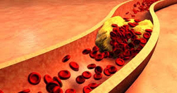 Mỡ máu có tác động như thế nào đến sức khỏe?
