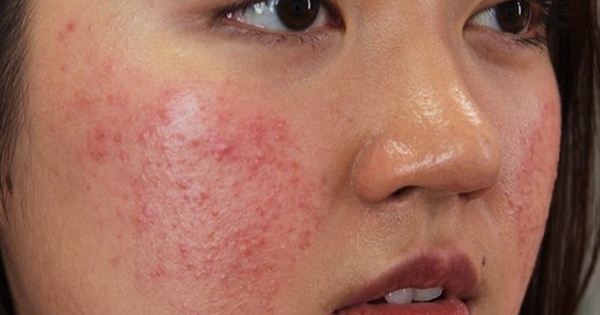 Làm thế nào để khắc phục tình trạng da mặt bị nổi mụn nước nhỏ?