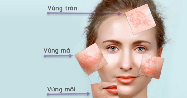 Tại sao áp dụng phác đồ điều trị riêng biệt có thể mang lại hiệu quả cao hơn trong việc điều trị nám mảng?

