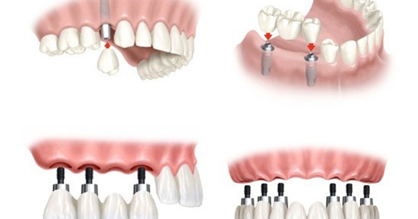 Có nên trồng răng implant để phục hình hiện đại trong nha khoa?