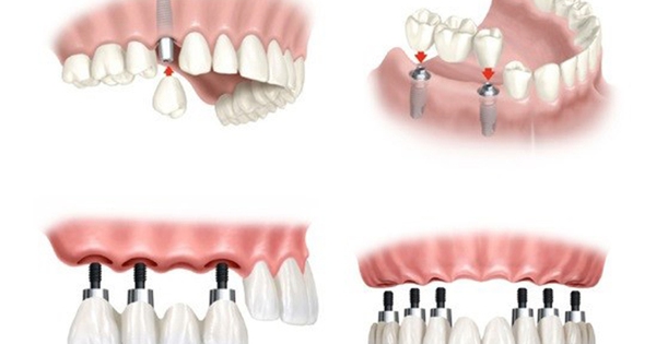 Có nên trồng răng implant để phục hình răng mất?