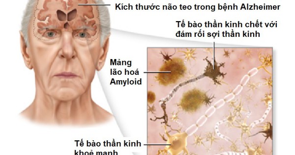 Bệnh bệnh eczema mất trí nhớ và những lưu ý khi chăm sóc sức khỏe