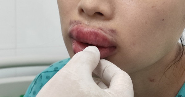 Có những biến chứng tiêm filler môi phổ biến nào?
