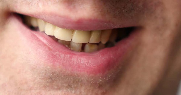 Những thói quen hàng ngày có thể gây ố vàng răng?
