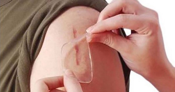  Miếng dán sẹo sau phẫu thuật : Tầm quan trọng và nguy cơ tiềm ẩn mà bạn cần nắm vững