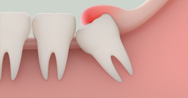 Lợi ích của việc súc miệng bằng nước muối sinh khi giảm đau sau khi nhổ răng?
