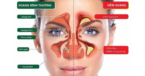 Viêm xoang có phải là một biến chứng phổ biến sau phẫu thuật nâng mũi?
