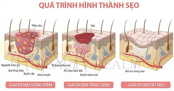 Những phương pháp điều trị nào được sử dụng để giảm thiểu sẹo lồi?
