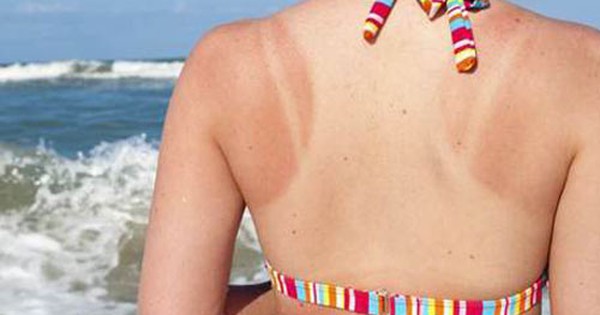 Có nên sử dụng kem chống nắng khi da đã bị ăn nắng?
