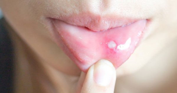Cách phòng ngừa và điều trị nhiệt miệng hiệu quả như thế nào?
