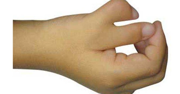 10 nguyên nhân gây phẫu thuật tay 6 ngón 