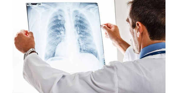Câu hỏi và giải đáp về ung thư phổi bị phù mặt 