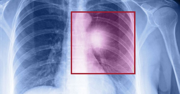 Cách ngăn ngừa và kiểm soát ung thư phổi di căn?
