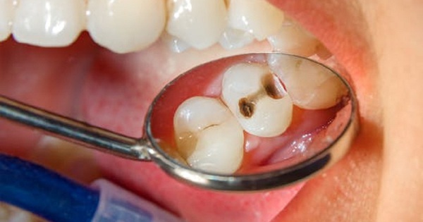 Các nguyên nhân gây sâu răng và hình thành lỗ trong răng?

