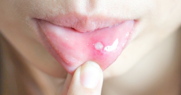 Có những thực phẩm nào nên tránh khi bị lở miệng?
