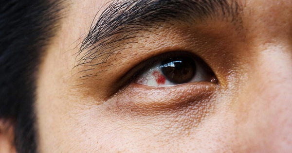 Mắt bị đốm đỏ là triệu chứng của bệnh gì?