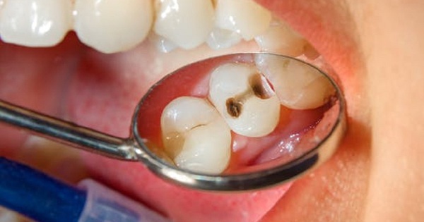 Những biểu hiện của răng sâu là gì? 
