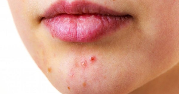 Làm thế nào để phân biệt mụn quanh miệng với các vấn đề da khác?
