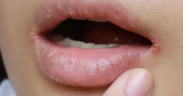 Khi nước bọt bay hơi, vùng da quanh miệng bị khô và dễ kích ứng, điều này có ý nghĩa gì?

