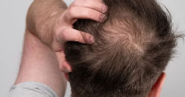 Viêm nang lông ở đầu có những triệu chứng như thế nào?
