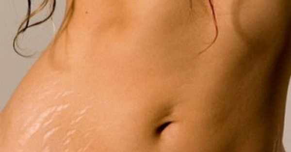 Làm thế nào để phòng ngừa rạn da ở mông?
