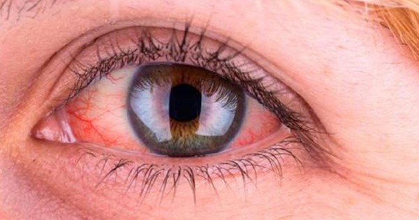 Nếu mắt bị đỏ 1 bên không đau có cần đi khám bác sĩ không?
