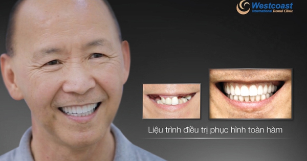 Làm thế nào để duy trì và chăm sóc răng implant sau khi trồng?
