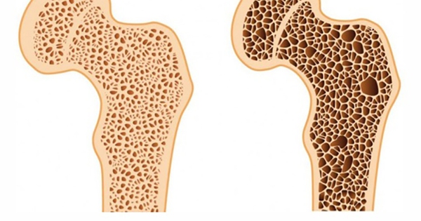 What are the dietary sources of calcium that are less likely to cause kidney stones?
