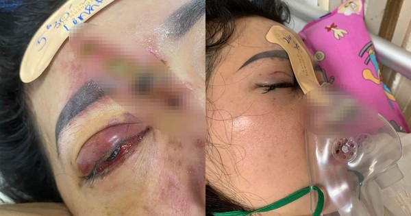 Fillers nâng mũi có nguy cơ gây biến chứng không?
