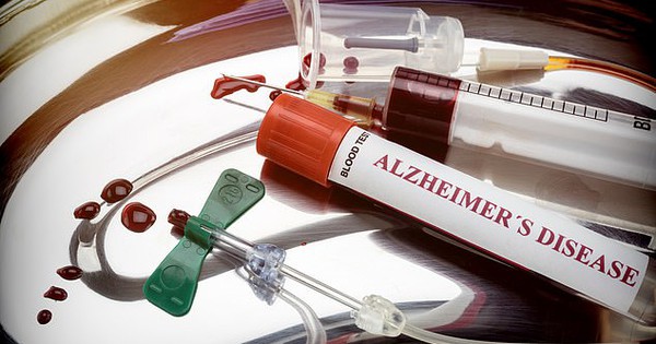 Đối tượng nào cần đặc biệt chú ý đến việc phòng ngừa bệnh Alzheimer?